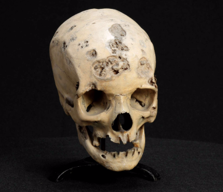 Skull with Syphilitic Necrotic 
